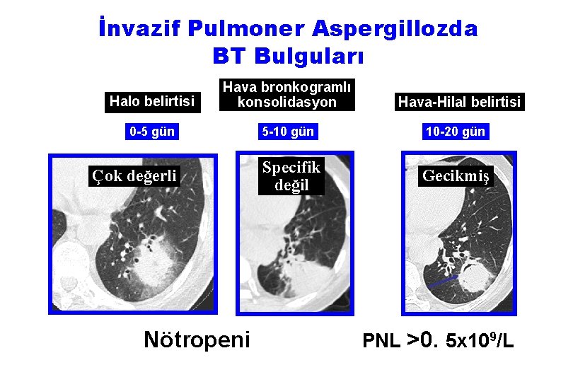 İnvazif Pulmoner Aspergillozda BT Bulguları Halo belirtisi Hava bronkogramlı konsolidasyon 0 -5 gün 5