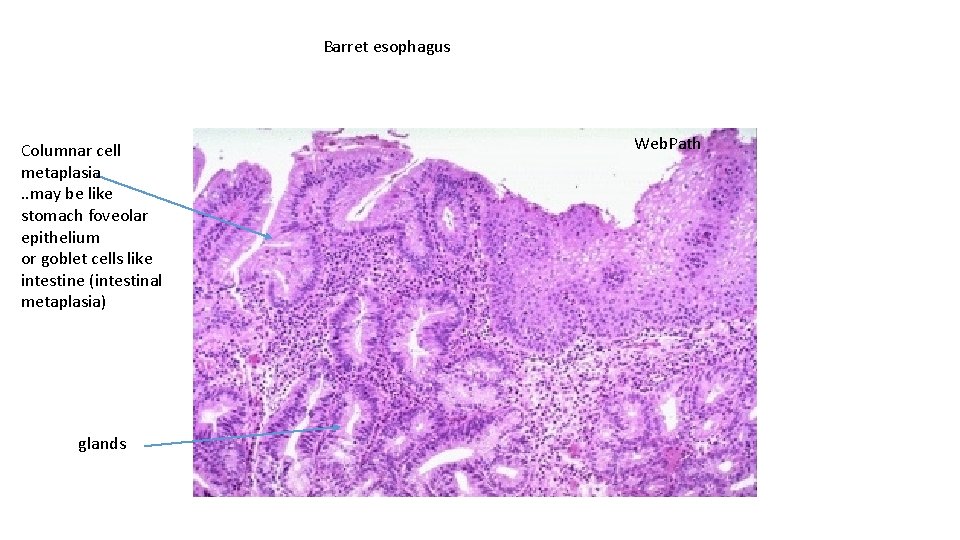 Barret esophagus Columnar cell metaplasia. . may be like stomach foveolar epithelium or goblet