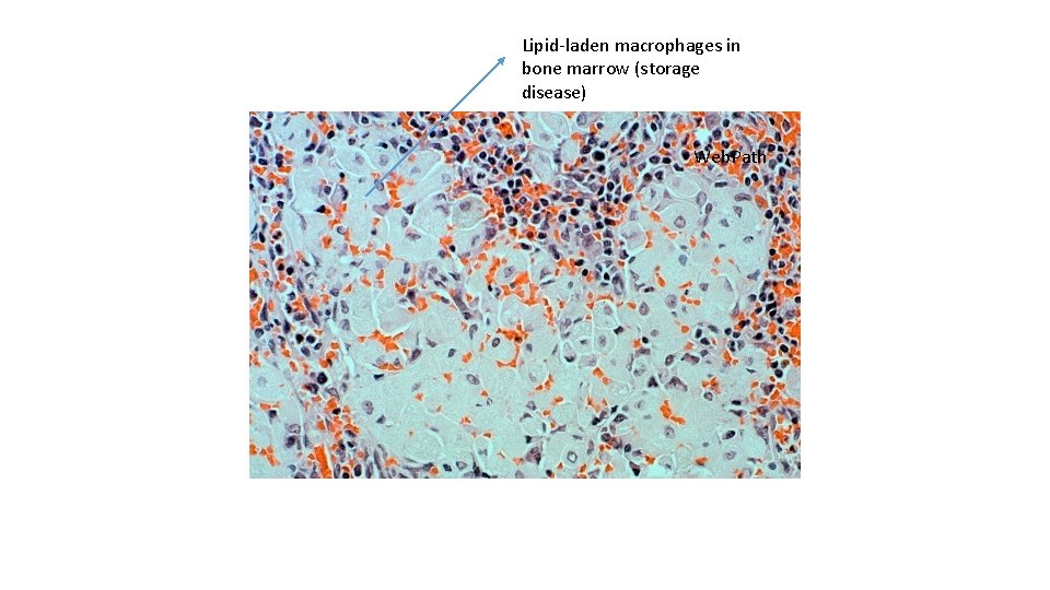 Lipid-laden macrophages in bone marrow (storage disease) Web. Path 