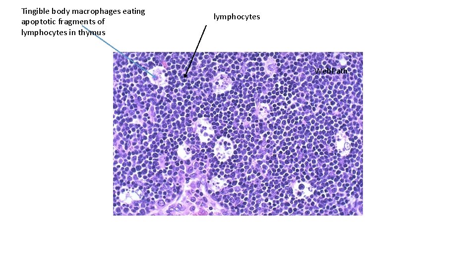 Tingible body macrophages eating apoptotic fragments of lymphocytes in thymus lymphocytes Web. Path 