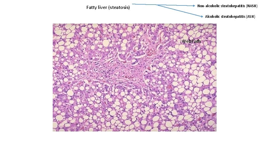 Fatty liver (steatosis) Non-alcoholic steatohepatitis (NASH) Alcoholic steatohepatitis (ASH) Web. Path 