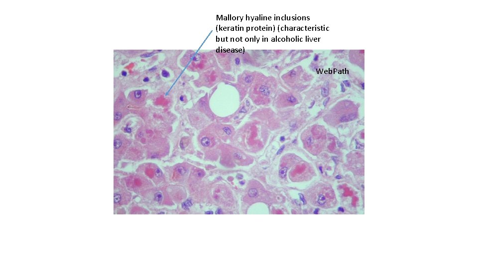 Mallory hyaline inclusions (keratin protein) (characteristic but not only in alcoholic liver disease) Web.