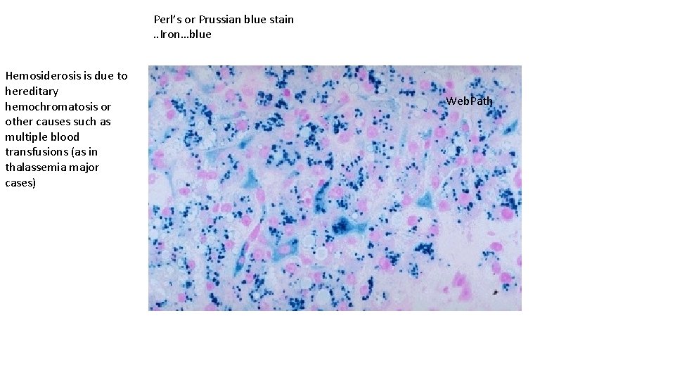 Perl’s or Prussian blue stain. . Iron…blue Hemosiderosis is due to hereditary hemochromatosis or