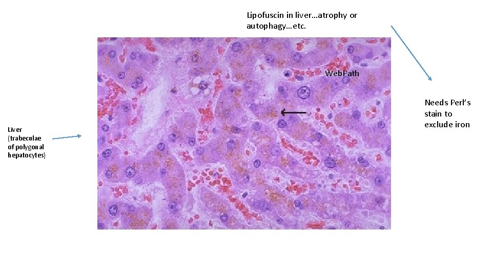Lipofuscin in liver…atrophy or autophagy…etc. Web. Path Liver (trabeculae of polygonal hepatocytes) Needs Perl’s