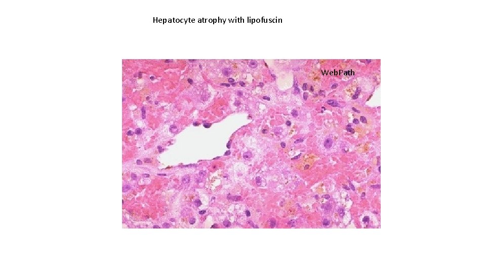 Hepatocyte atrophy with lipofuscin Web. Path 
