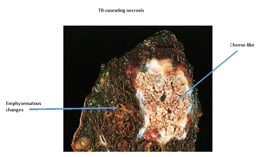 TB-caseating necrosis Robbins Emphysematous changes Cheese-like 