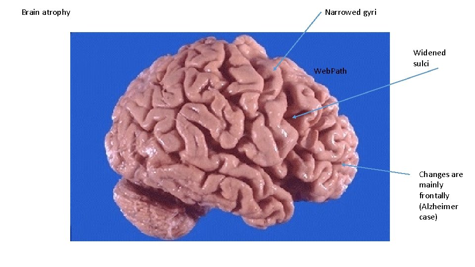 Brain atrophy Narrowed gyri Web. Path Widened sulci Changes are mainly frontally (Alzheimer case)