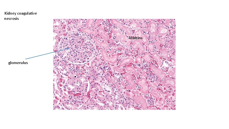 Kidney coagulative necrosis Robbins glomerulus 