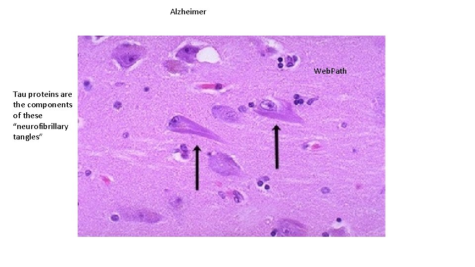 Alzheimer Web. Path Tau proteins are the components of these “neurofibrillary tangles” 