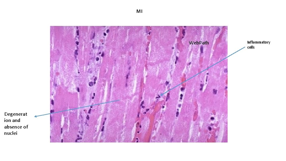 MI Web. Path Degenerat ion and absence of nuclei Inflammatory cells 