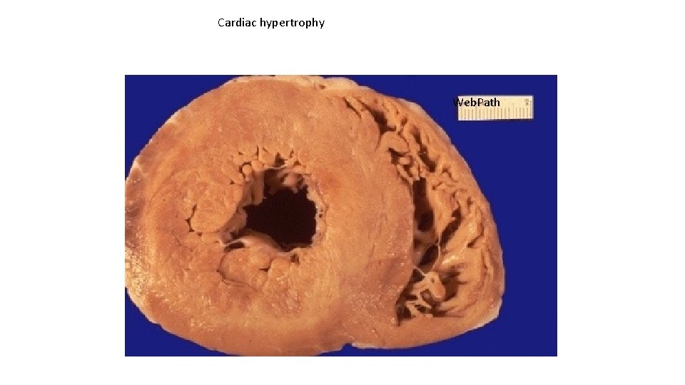 Cardiac hypertrophy Web. Path 