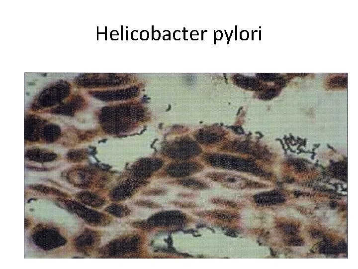 Helicobacter pylori 