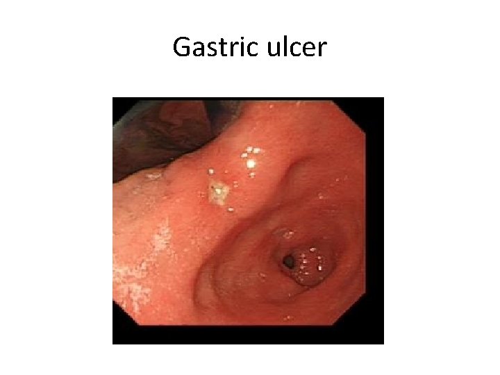 Gastric ulcer 
