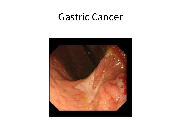 Gastric Cancer 