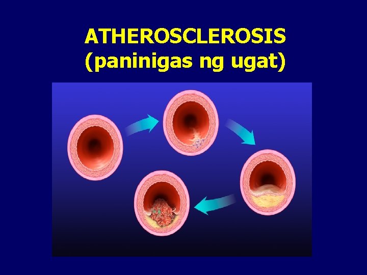 ATHEROSCLEROSIS (paninigas ng ugat) 