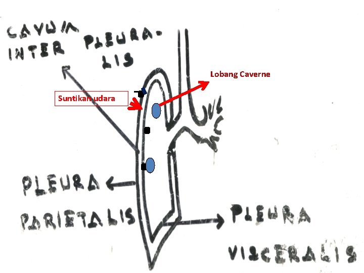 Lobang Caverne Suntikan udara 