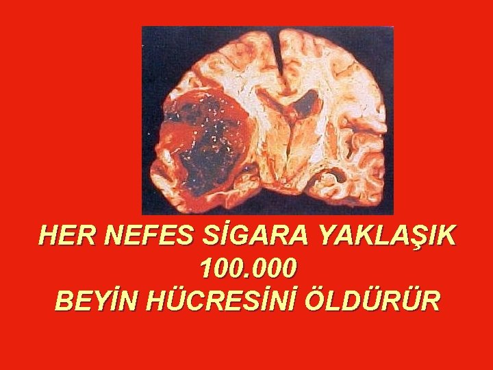 HER NEFES SİGARA YAKLAŞIK 100. 000 BEYİN HÜCRESİNİ ÖLDÜRÜR 