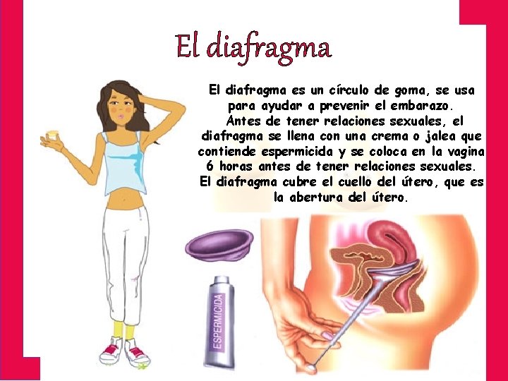 El diafragma es un círculo de goma, se usa para ayudar a prevenir el