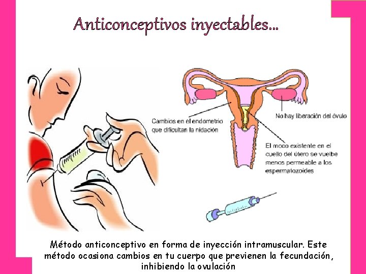 Anticonceptivos inyectables… Método anticonceptivo en forma de inyección intramuscular. Este método ocasiona cambios en