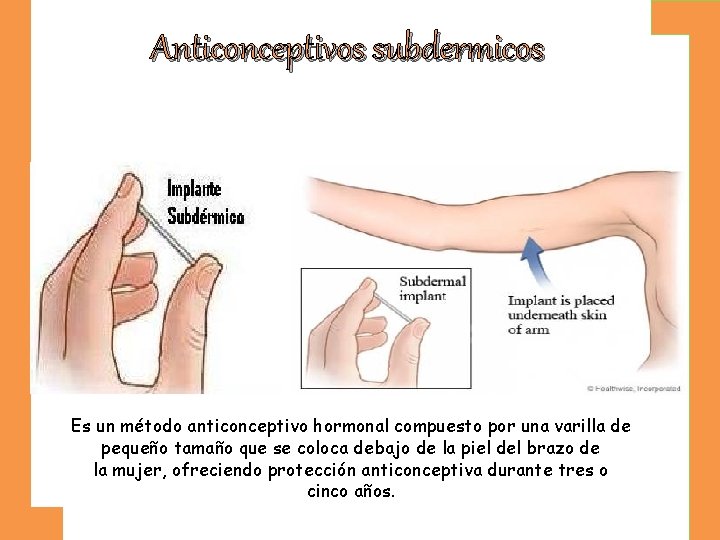 Anticonceptivos subdermicos Es un método anticonceptivo hormonal compuesto por una varilla de pequeño tamaño