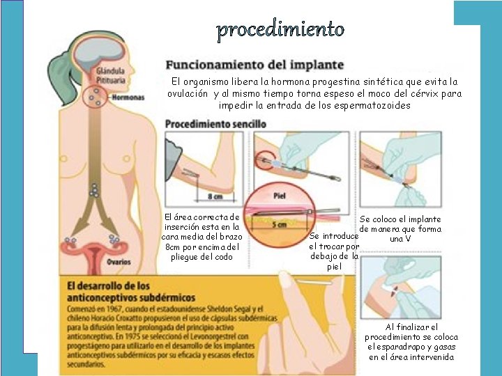 procedimiento El organismo libera la hormona progestina sintética que evita la ovulación y al