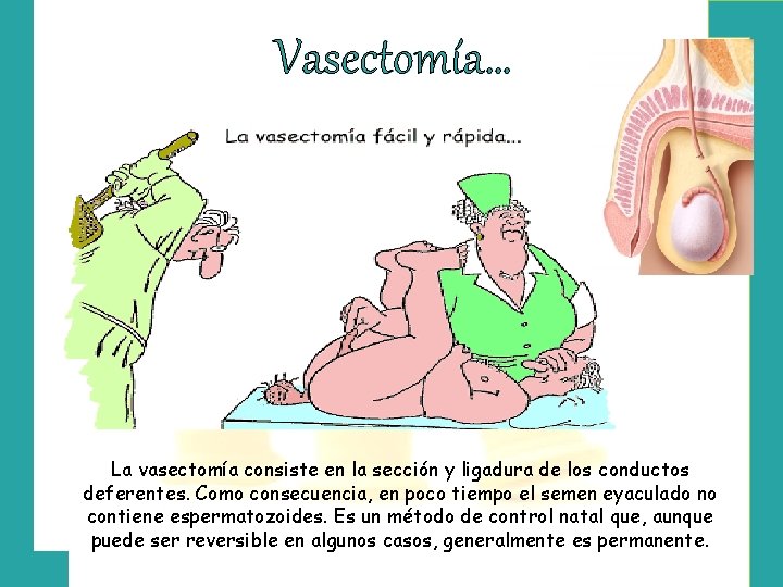 Vasectomía… La vasectomía consiste en la sección y ligadura de los conductos deferentes. Como