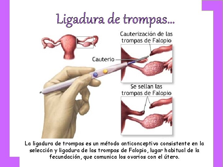 Ligadura de trompas… La ligadura de trompas es un método anticonceptivo consistente en la