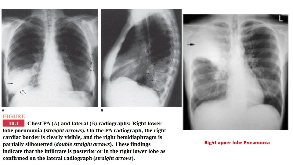 Right upper lobe Pneumonia 