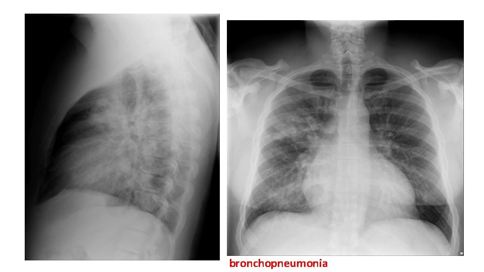 bronchopneumonia 