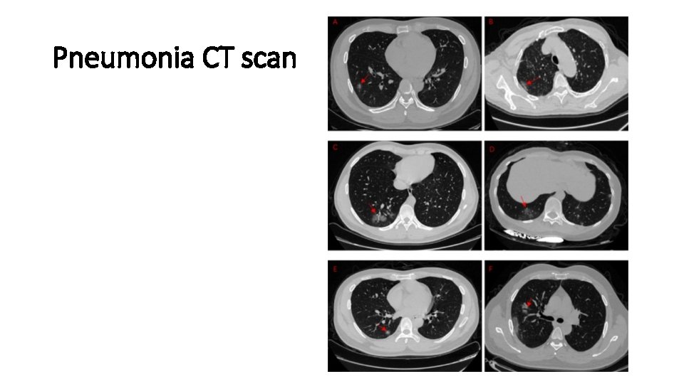 Pneumonia CT scan 