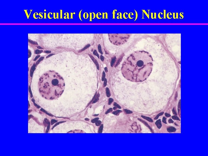 Vesicular (open face) Nucleus 