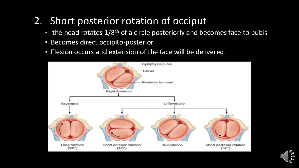 2. Short posterior rotation of occiput • the head rotates 1/8 th of a