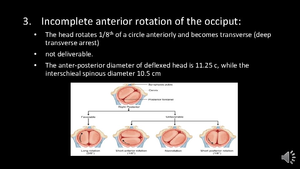 3. Incomplete anterior rotation of the occiput: • • • The head rotates 1/8