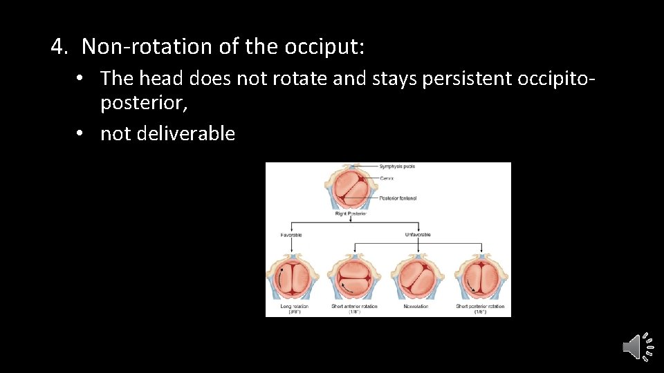 4. Non-rotation of the occiput: • The head does not rotate and stays persistent