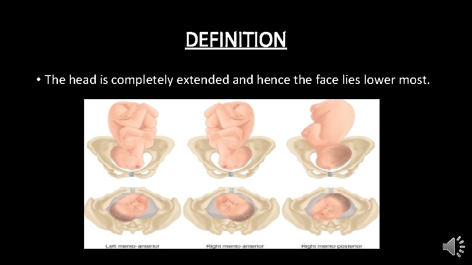 DEFINITION • The head is completely extended and hence the face lies lower most.