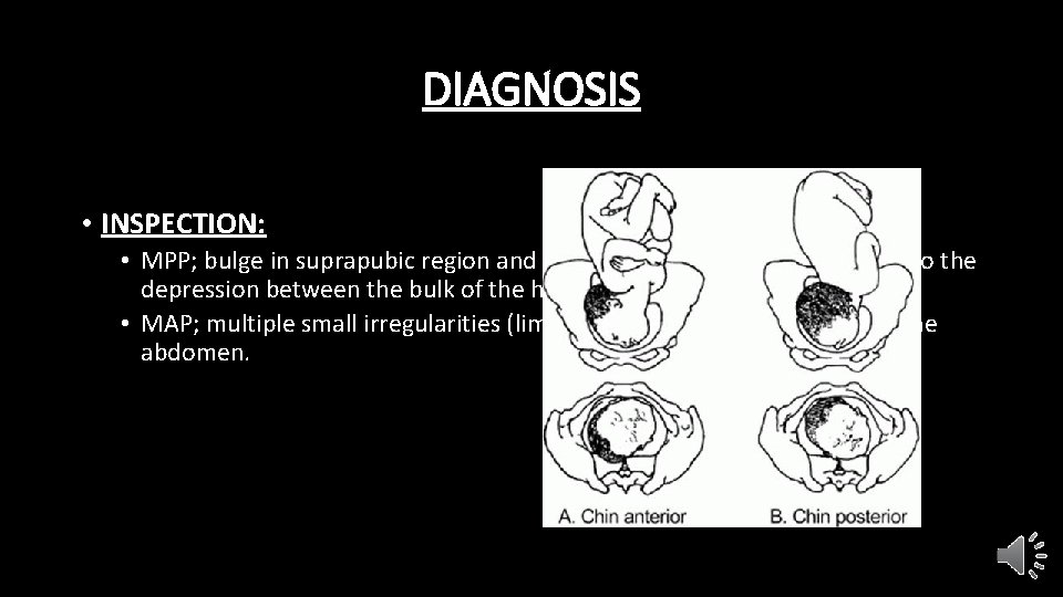 DIAGNOSIS • INSPECTION: • MPP; bulge in suprapubic region and groove blow the umbilicus,