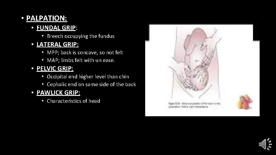  • PALPATION: • FUNDAL GRIP: • Breech occupying the fundus • LATERAL GRIP: