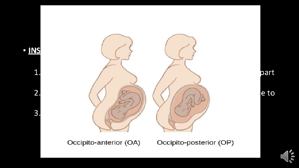 DIAGNOSIS • INSPECTION: 1. Loss of normal abdominal contour with flattening and lower part