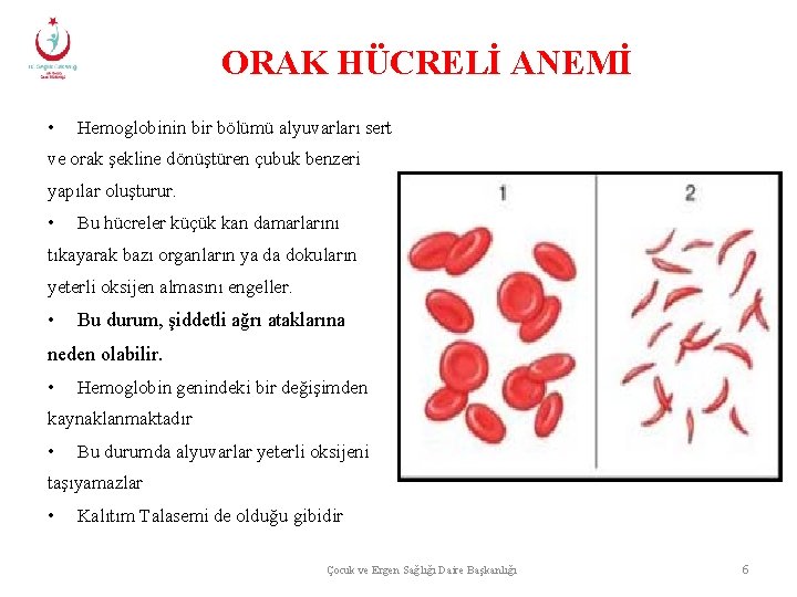 ORAK HÜCRELİ ANEMİ • Hemoglobinin bir bölümü alyuvarları sert ve orak şekline dönüştüren çubuk