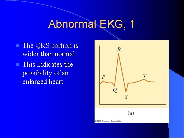 Abnormal EKG, 1 The QRS portion is wider than normal l This indicates the