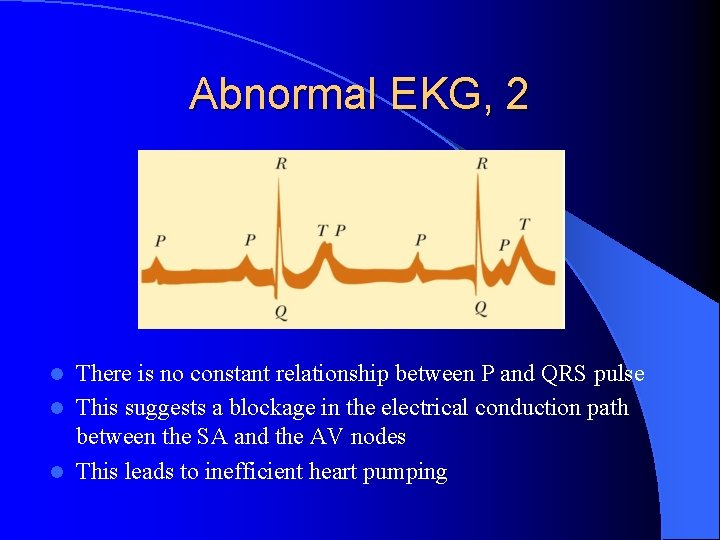 Abnormal EKG, 2 There is no constant relationship between P and QRS pulse l