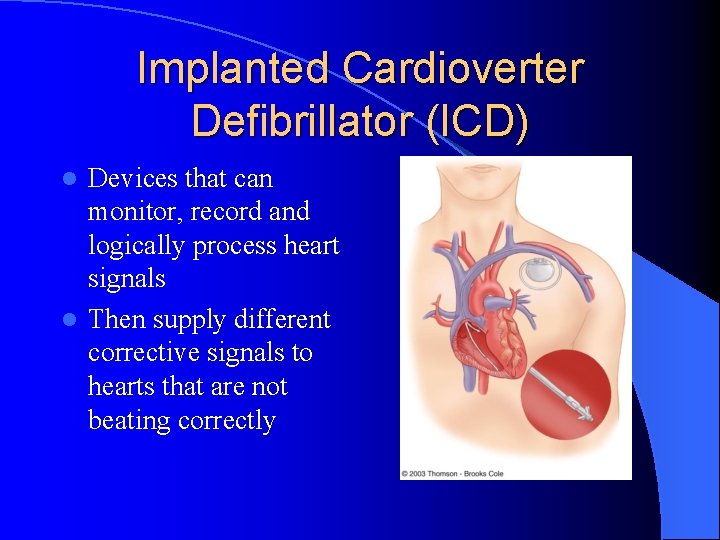 Implanted Cardioverter Defibrillator (ICD) Devices that can monitor, record and logically process heart signals