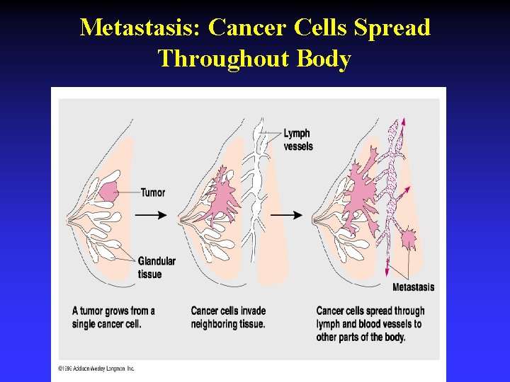 Metastasis: Cancer Cells Spread Throughout Body 