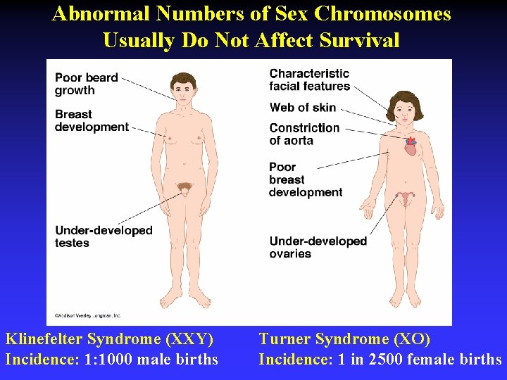 Abnormal Numbers of Sex Chromosomes Usually Do Not Affect Survival Klinefelter Syndrome (XXY) Incidence: