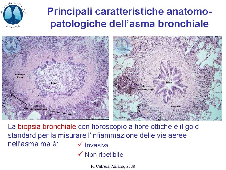 Principali caratteristiche anatomopatologiche dell’asma bronchiale La biopsia bronchiale con fibroscopio a fibre ottiche è