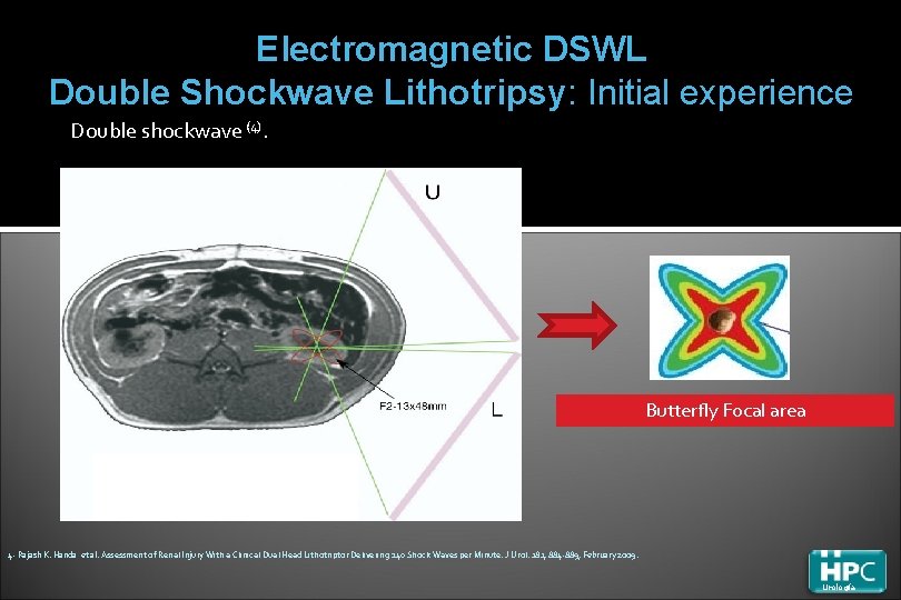 Electromagnetic DSWL Double Shockwave Lithotripsy: Initial experience Double shockwave (4). Butterfly Focal area 4