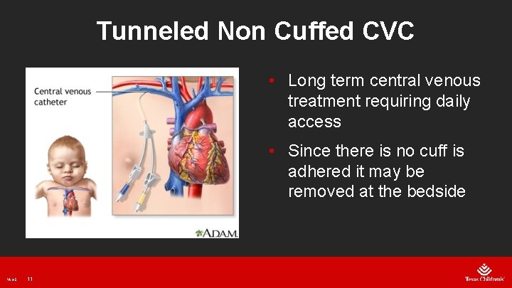 Tunneled Non Cuffed CVC • Long term central venous treatment requiring daily access •