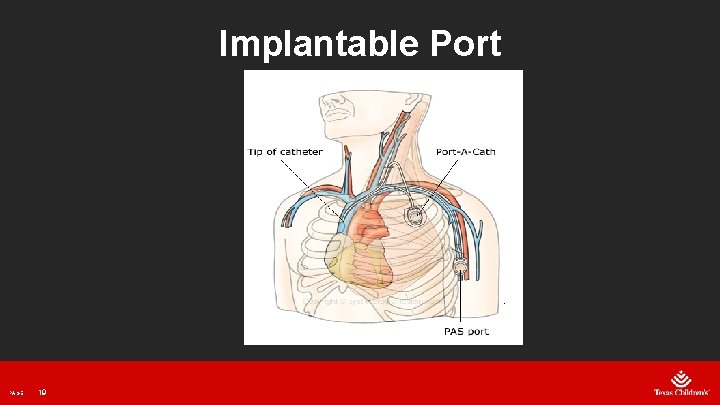 Implantable Port PAGE 19 
