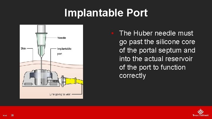 Implantable Port • The Huber needle must go past the silicone core of the