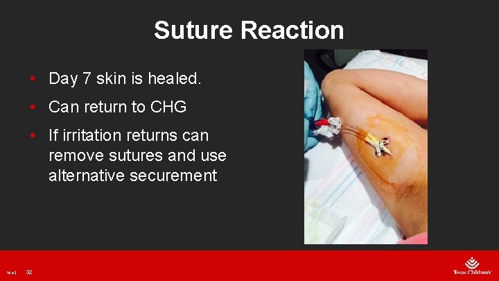 Suture Reaction • Day 7 skin is healed. • Can return to CHG •